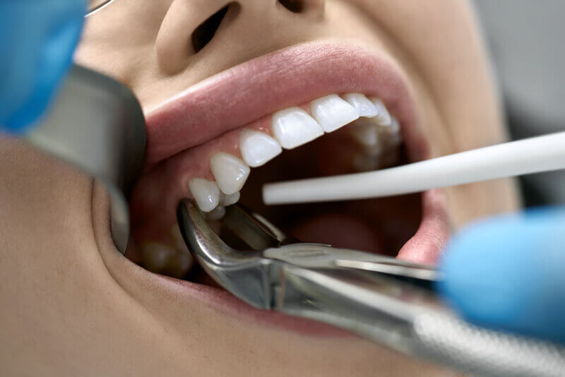 How Does Tooth Removal Treat Severe Gum Disease