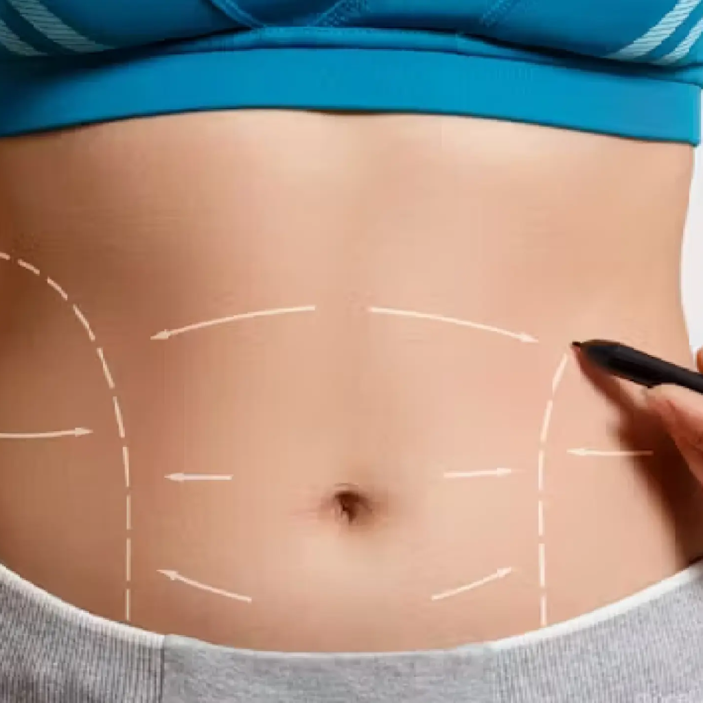 How Does a Mini Tummy Tuck Work for Quick Results