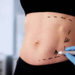 How Does a Tummy Tuck Improve Abdominal Shape