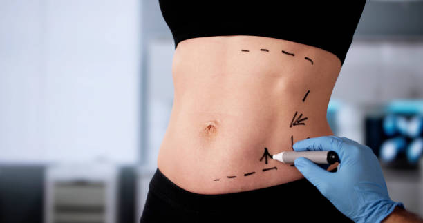 How Does a Tummy Tuck Improve Abdominal Shape