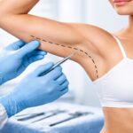 How Does an Arm Lift Improve Upper Arm Shape?