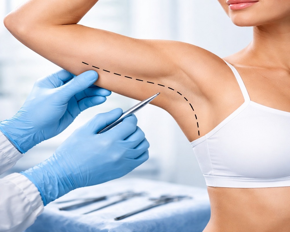 How Does an Arm Lift Improve Upper Arm Shape?