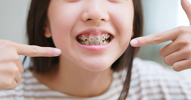 How Effective Are Dental Braces for Straightening Teeth?