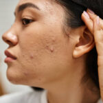 How Effective Is Acne Treatment for Severe Breakouts