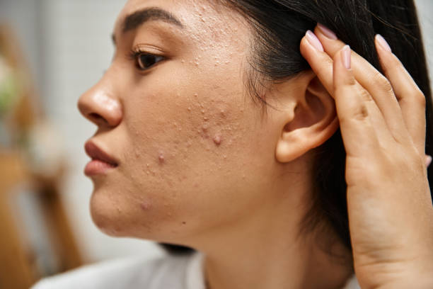 How Effective Is Acne Treatment for Severe Breakouts