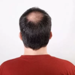 How Effective Is Crown Hair Transplant for Balding