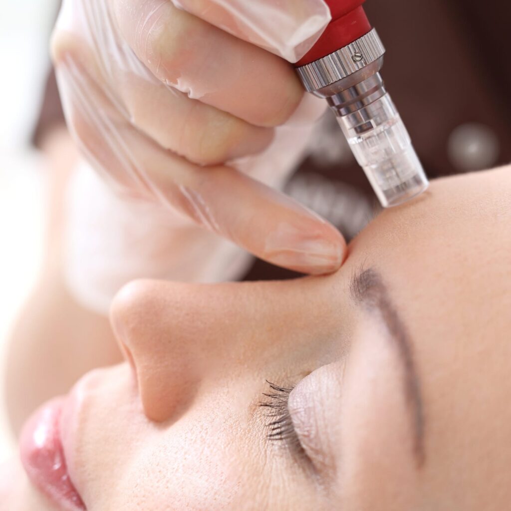 How Effective Is Microneedling for Acne Scars Today
