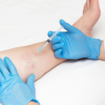 How Effective Is Varicose Veins Treatment for Relief