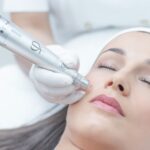 How Long Do Results of RF Microneedling Last