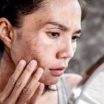 How Melasma Treatment Helps Achieve Even Skin