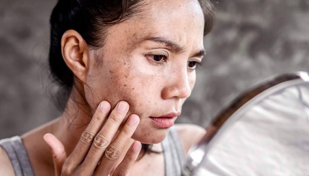How Melasma Treatment Helps Achieve Even Skin