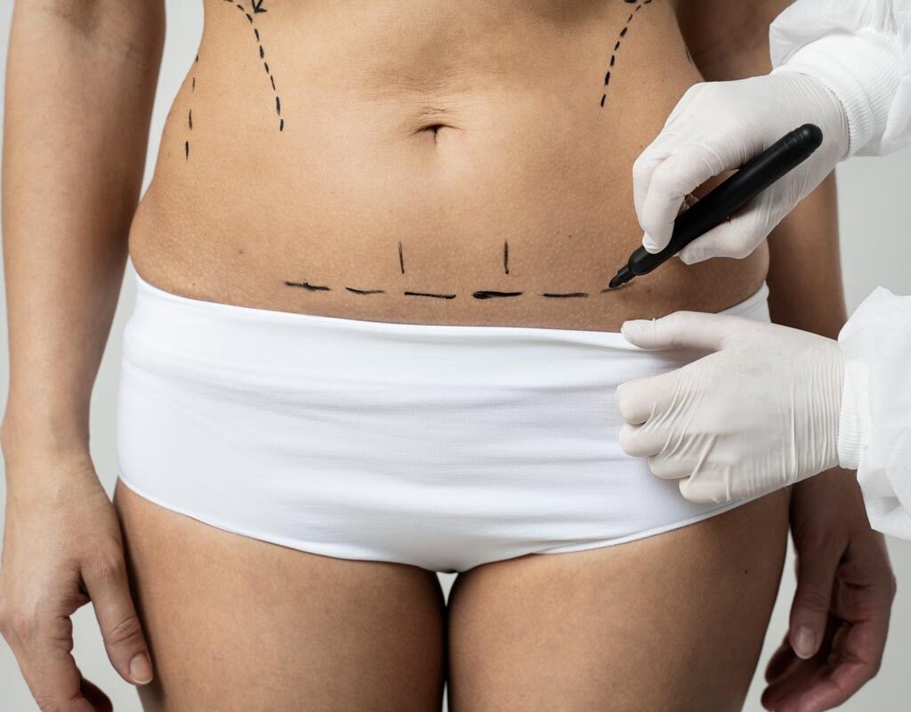 How Mini Abdominoplasty Improves Your Waistline Shape