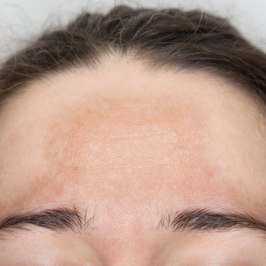 How Pigmentation Treatment Brightens Dull Skin