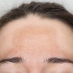 How Pigmentation Treatment Brightens Dull Skin