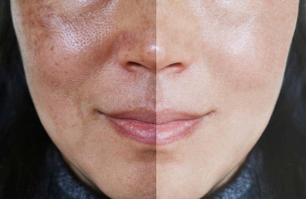 How Safe Is Pigmentation Treatment for Face