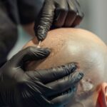 How Scalp Micropigmentation Covers Bald Spots