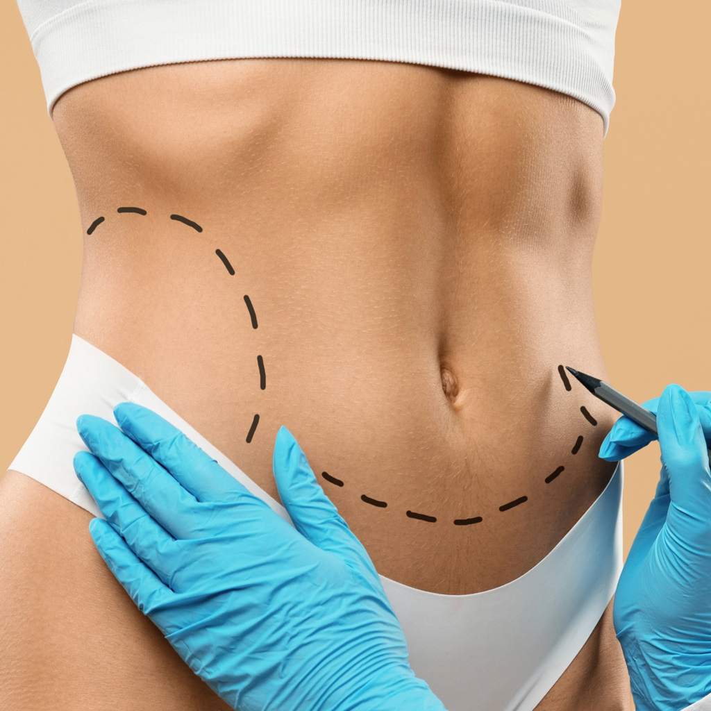 How Waist Sculpting Shapes a Slimmer Midsection