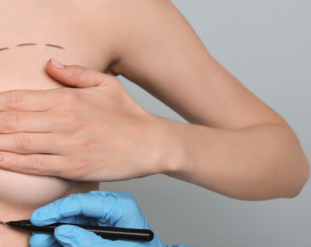 How to Prepare for Breast Augmentation Surgery