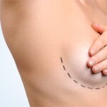 Is Breast Augmentation Surgery Right for You
