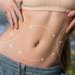 Is Liposuction Suitable for Belly Fat Treatment