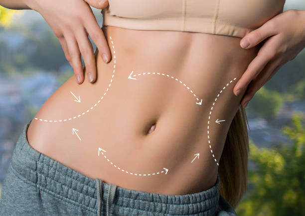 Is Liposuction Suitable for Belly Fat Treatment