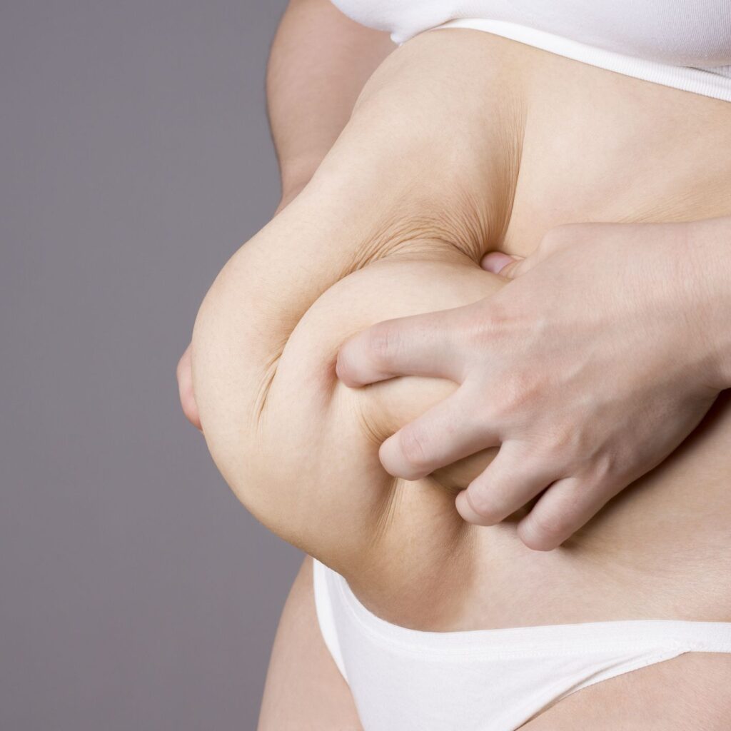 Is Mini Abdominoplasty a Permanent Solution