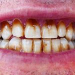 Is Smoking Weed Bad for Teeth