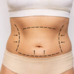 Is Tummy Tuck a Permanent Solution for Belly Fat
