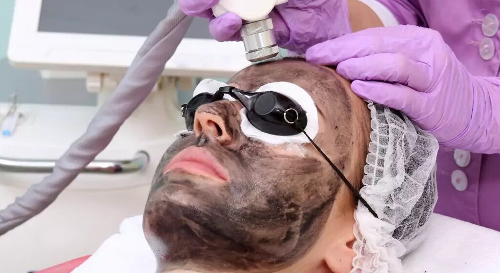 Laser Carbon Peel for Youthful, Refreshed Skin