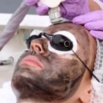 Laser Carbon Peel for Youthful, Refreshed Skin