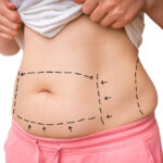 Mini Abdominoplasty Subtle Changes, Meaningful Results
