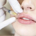 Russian Lip Fillers Designed for Natural Balance