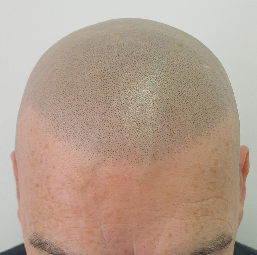 Scalp Micropigmentation A Proven Solution for Baldness
