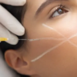 Sculptra Treatment Process and Benefits