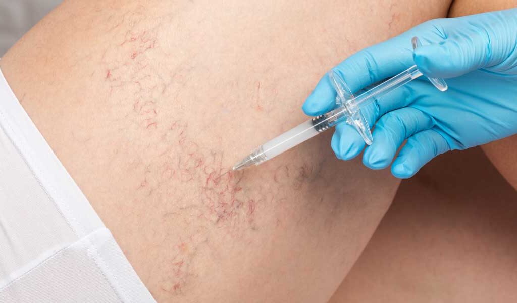 Step Into Confidence with Spider Veins Removal