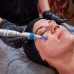 What Makes Dermapen Results Look Natural