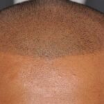 What Makes SMP Results Long Lasting