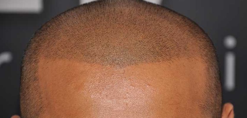 What Makes SMP Results Long Lasting