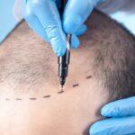 What Results Can You Expect From an FUE Hair Transplant?