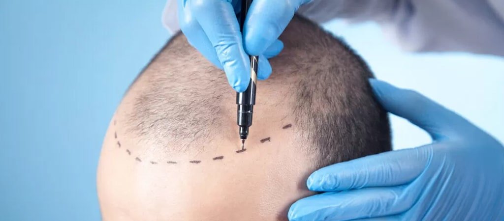 What Results Can You Expect From an FUE Hair Transplant?