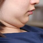 Double chin liposuction in Islamabad