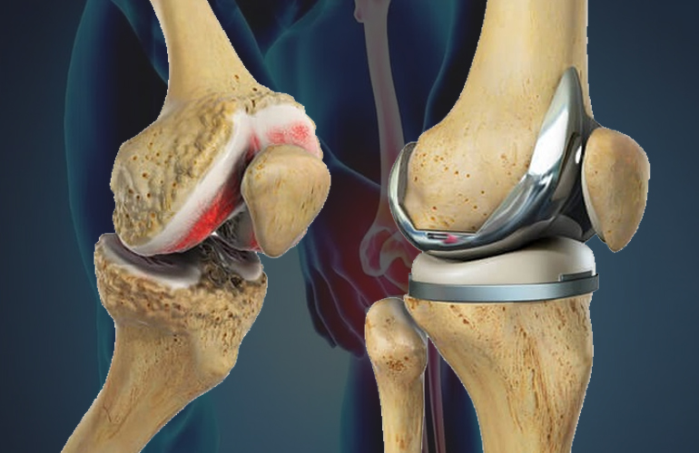 Knee Replacement in Jaipur