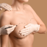 Breast Implant Surgery Designed for Natural Proportions