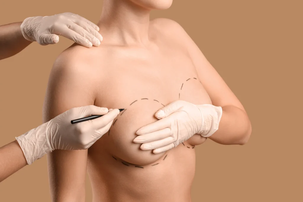 Breast Implant Surgery Designed for Natural Proportions