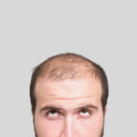 Can Crown Hair Transplant Fix Bald Spots