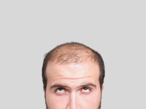 Can Crown Hair Transplant Fix Bald Spots