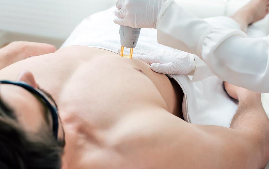 Full Body Laser Hair Removal Cost In Dubai for a Clear Skin