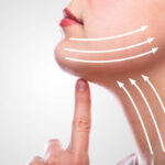 Can Neck Lift Remove Double Chin