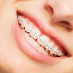 Can Teens Benefit from Dental Braces