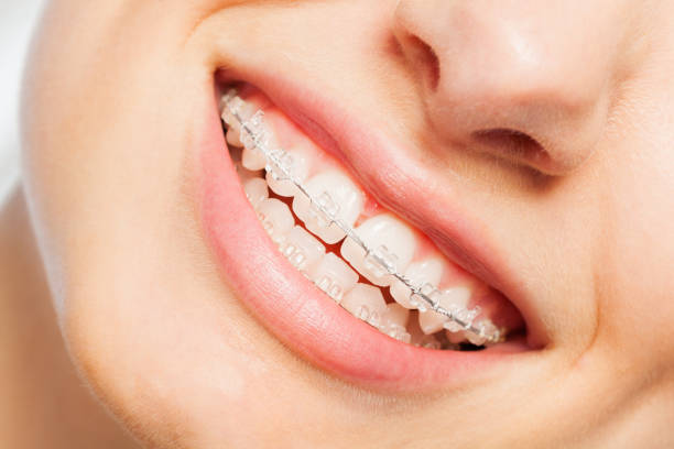 Can Teens Benefit from Dental Braces